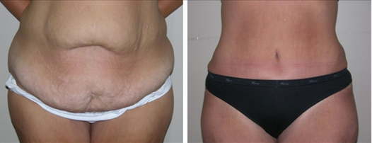Body Lift Actual Patient results