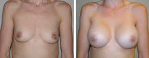 Image - Two Approaches to Breast Reconstruction