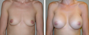 Breast Implant Before and After