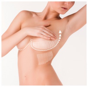 Breast Lift Surgery