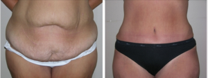 Before and After Tummy Tuck Surgery