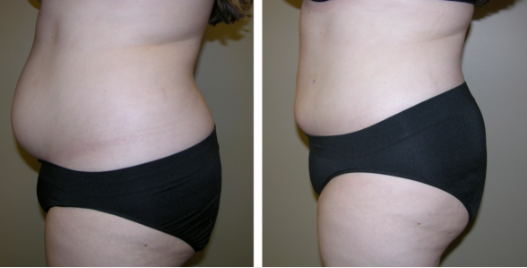 Image - How to Know if You Are a Good Candidate for Liposuction