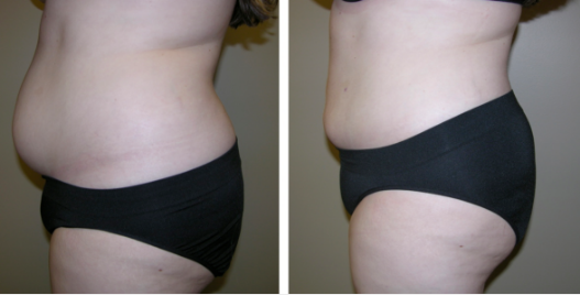 Liposuction Before and After Photos