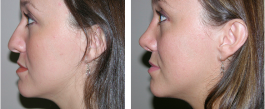 Before and After Rhinoplasty