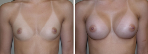 Image - What Breast Implants Should I Get?