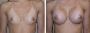 Before and After Breast Augmentation