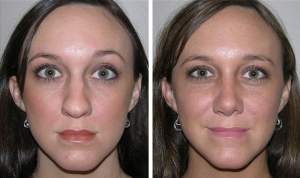 Before and After Rhinoplasty