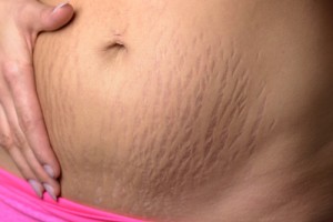 Image - Treat Stretch Marks With the Apollo™ System Powered by TriPollar