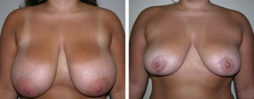 Breast Reduction Dr. Oliver & Jack Patient