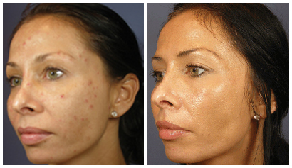 VI Peel Before and After 1