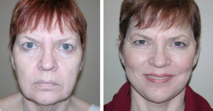 birmingham specialists facelift patient