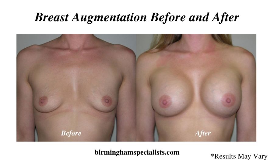 A woman before and after her breast augmentation surgery with implants in Birmingham, Alabama.
