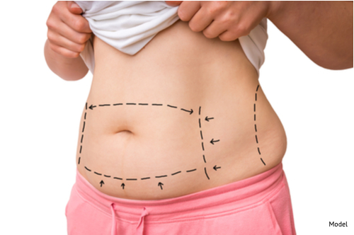 Image - 3 Things You Should Know About Tummy Tuck Surgery