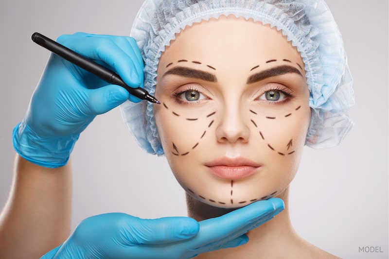 Woman preparing for facelift surgery with surgical lines being drawn on face.