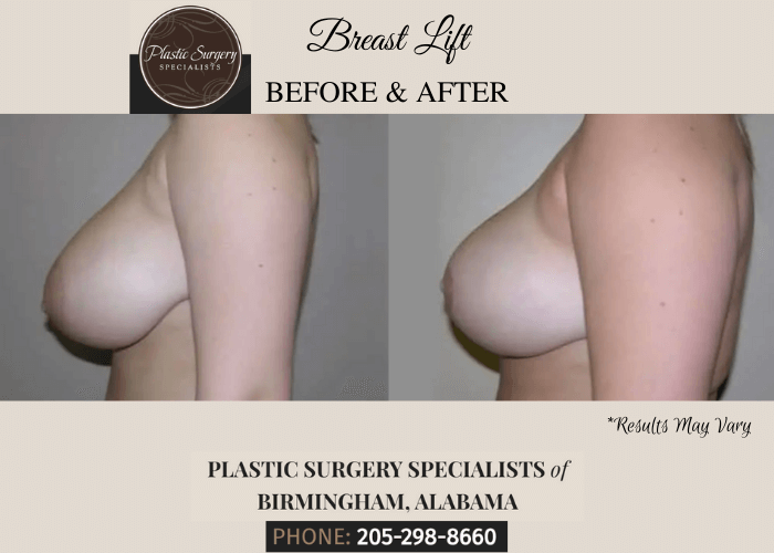 Before and after image showing the results of a breast lift performed in Birmingham, AL.