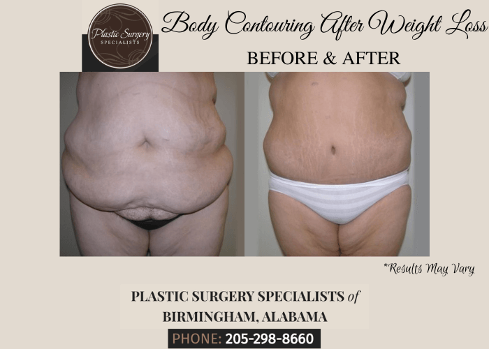 Before and after showing body contouring after weight loss surgery performed in Birmingham, AL.