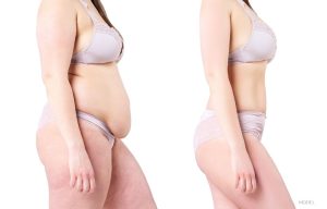 Woman before and after a tummy tuck or weight loss.