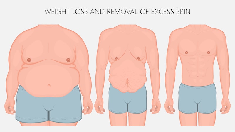 illustration of weight loss, the resulting loose skin, and improved appearance after cosmetic surgery.