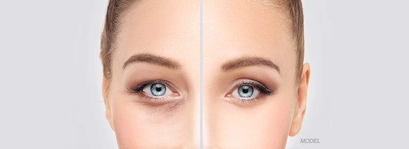 Before and after image of a woman with eyelid surgery.