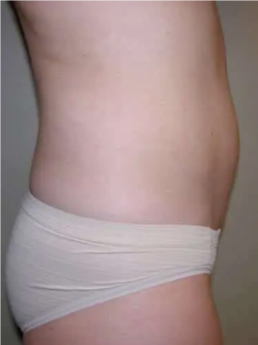 Liposuction Patient 01. After