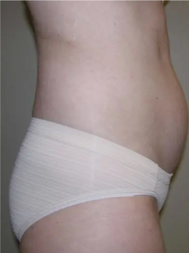 Liposuction Patient 01. Before