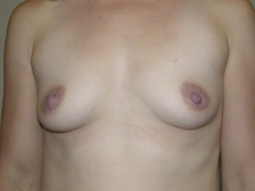 Breast Augmentation Patient 03 Before