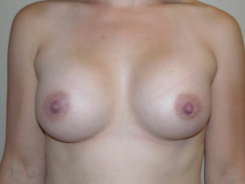 Breast Augmentation Patient 03 After