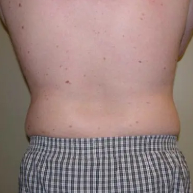 Liposuction Patient 02. After