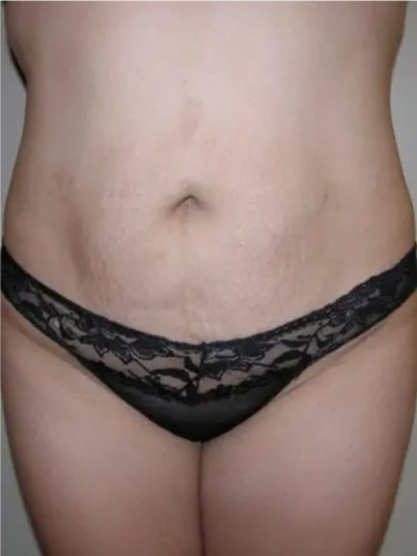 Liposuction Patient 03. After