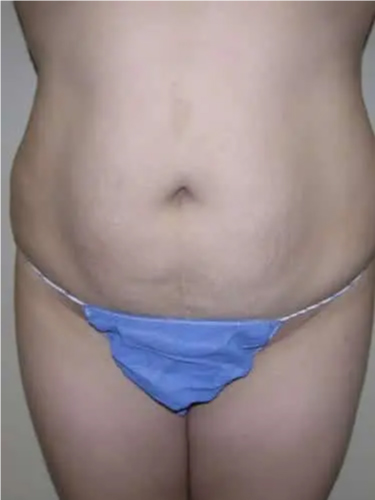Liposuction Patient 03. Before