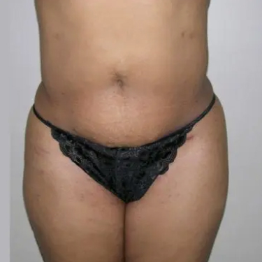 Liposuction Patient 04. After