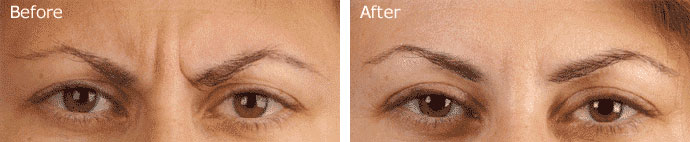 Botox Patient 01