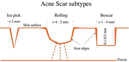 Acne Scheme