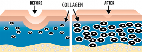 Acne surface diagram