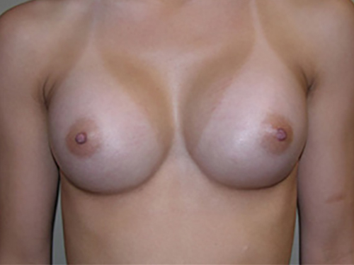 Breast Augmentation Patient 01 After