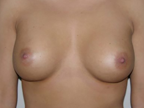 Breast Augmentation Patient 02 After