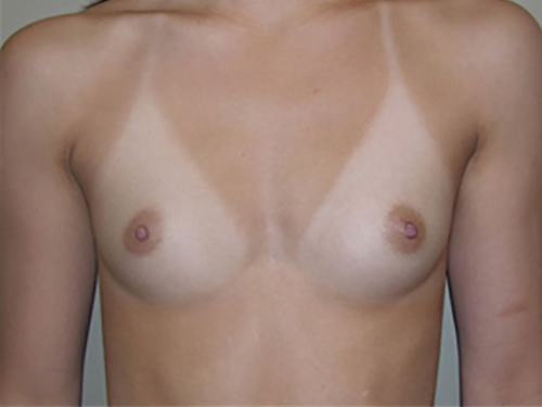 Breast Augmentation Patient 01 Before