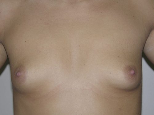 Breast Augmentation Patient 02 Before