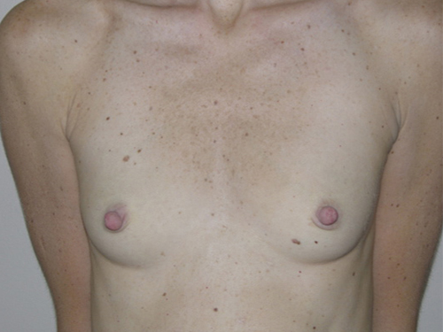 Breast Augmentation Patient 04 Before