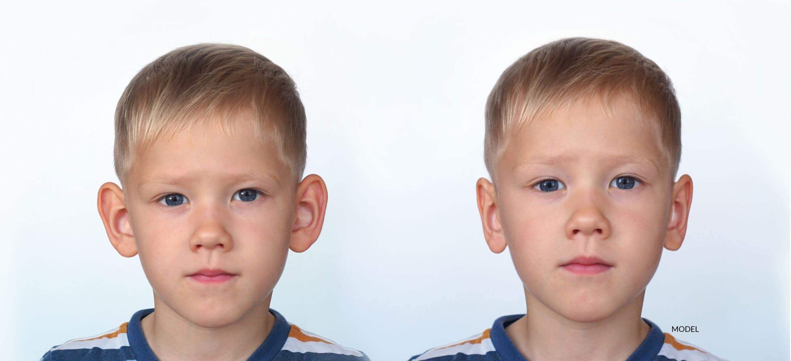 Boy - before and after otoplasty.