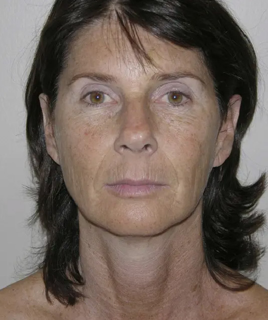 Facelift patient 01 before forward facing