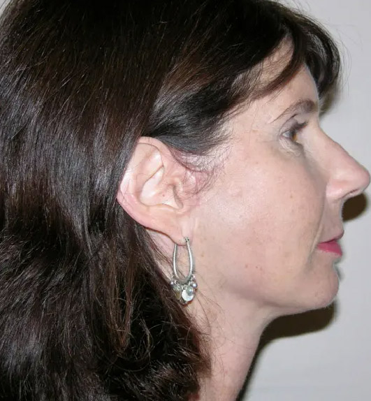 Facelift patient 01 after side facing