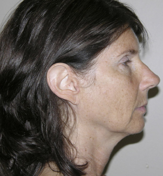 Facelift patient 01 before side facing