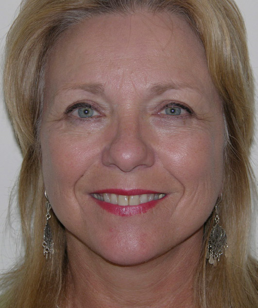 Facelift patient 02 after forward facing