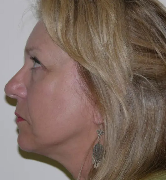 Facelift patient 02 after side facing