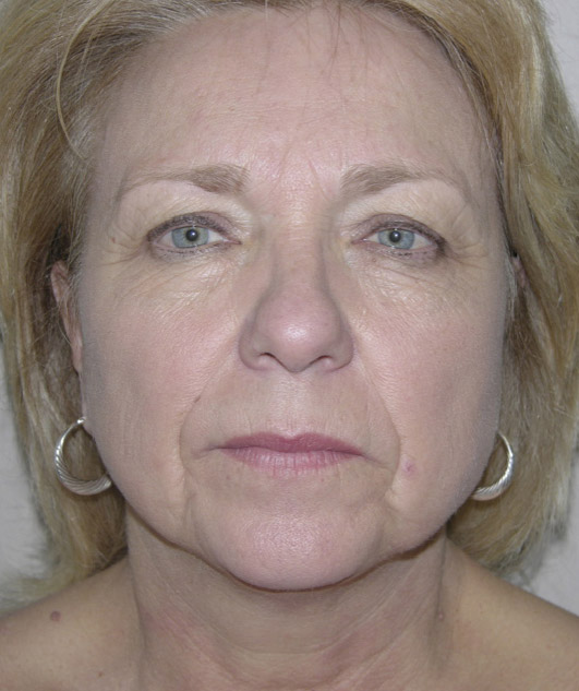 Facelift patient 02 before forward facing