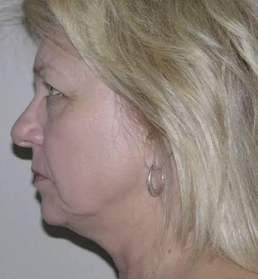 Facelift patient 02 before side facing