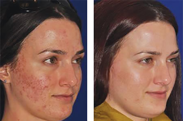 Acne Scars actual patient