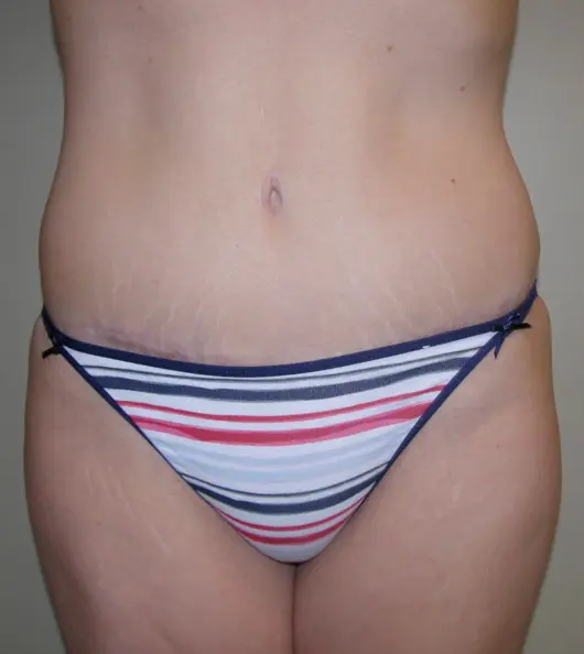 Tummy tuck after patient 3 forward facing