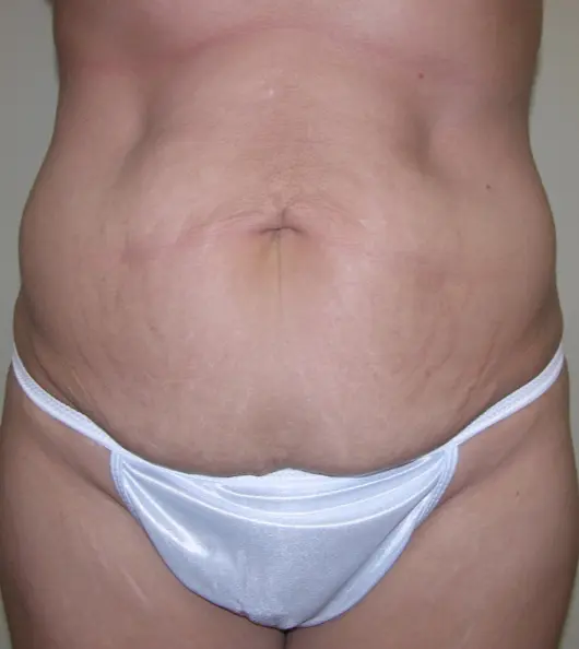 Tummy tuck before patient 3 forward facing